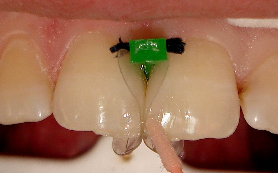 Icuri pene interdentare plastic verzi 1840 80 buc Icuri pene interdentare plastic verzi 1840 80 buc - imagine 2