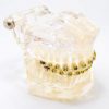 Model typodont orto transparent bracketi metalici tipodont