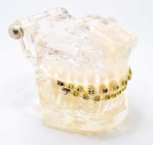 Model typodont orto transparent bracketi metalici tipodont