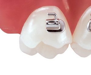 Tubusoare ortodontice molar 2 set 4 buc