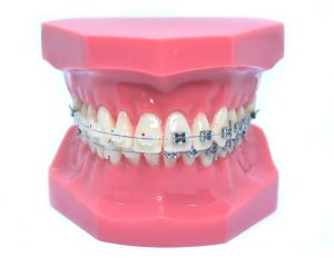 Model typodont orto roz cu bracketi metalici și ceramici