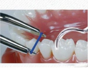 Cleste aplicator elastice de separare orto