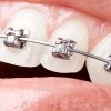 Bracketi autoligaturanti metalici Tellus natural USA