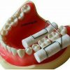 Fixator intraoral de rulouri portrulou TOR VM 1010
