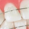 Bracketi din ceramica Denxy Bracketi din ceramica Denxy