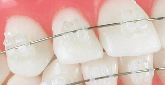 Bracketi din ceramica Denxy Bracketi din ceramica Denxy