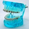 Model typodont orto albastru cu bracketi metalici