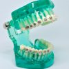 Model typodont orto semitransparent cu bracketi ceramici si metalici