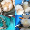 Matrici metalice interdentare tip PALODENT mici 10971(50)