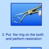 Matrici metalice interdentare tip PALODENT mici 10971(50)