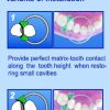 Matrici metalice interdentare tip PALODENT mici 10971(50)
