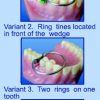Matrici metalice interdentare tip PALODENT mici 10971(50)