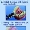 Matrici metalice interdentare tip PALODENT mici 10971(50)