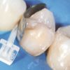 Icuri pene interdentare plastic transparent 1820 80 buc