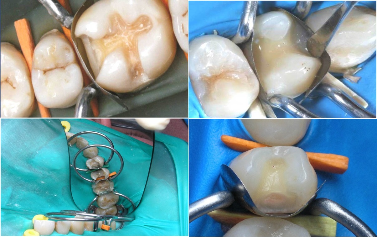 Matrici metalice interdentare tip PALODENT 1198 Matrici metalice interdentare tip PALODENT 1198 - imagine 2