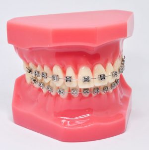 Model typodont orto roz cu bracketi metalici
