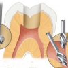 Gates freze 6buc/cut