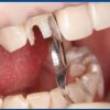 Matrici benzi anterioare twin duble proximale 1523 TOR VM