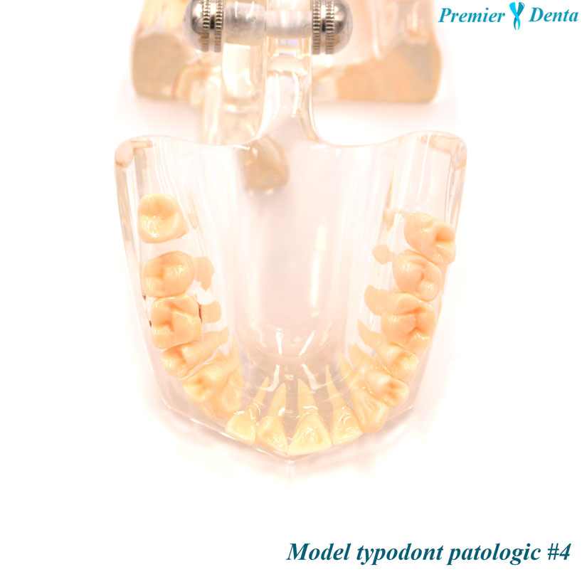 Model typodont patologic model 4 Model typodont patologic model 4 - imagine 4