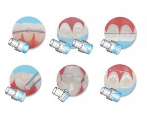 Set 6 conformatoare silicon pentru accesorii ortodontice din compozit
