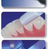 Set 6 conformatoare silicon pentru accesorii ortodontice din compozit Set 6 conformatoare silicon pentru accesorii ortodontice din compozit