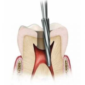Freza CB 152 tip ENDO Z pentru largirea camerei pulpare extradura cu varf inactiv Verdent