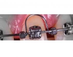 Arc torsiune Torque Spring 1G Universal 10 buc
