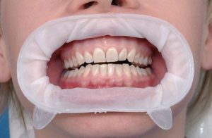 Optragate 3D Refill diga Ivoclar