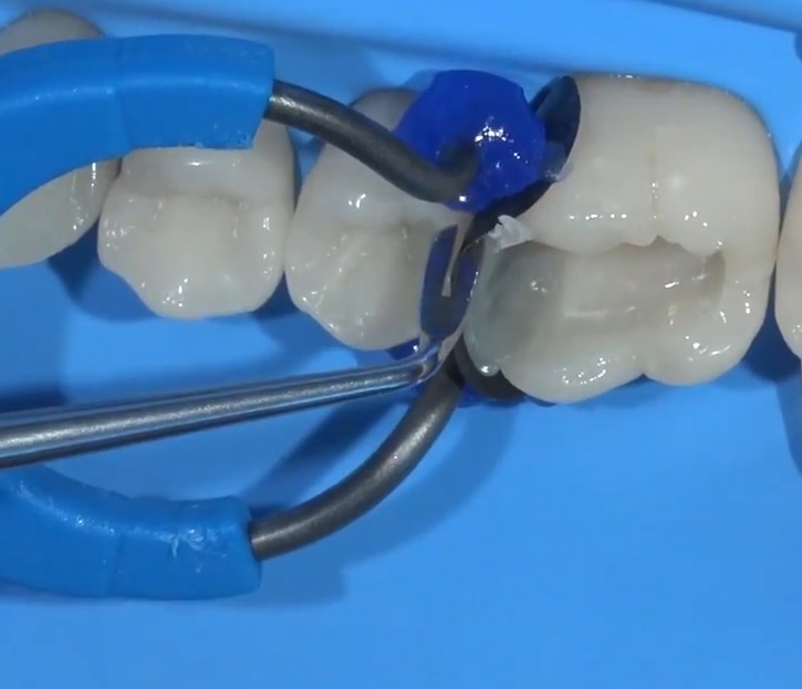Instrument modelat compozit posterior S60(12) S300(19) Instrument modelat compozit posterior S60(12) S300(19) - imagine 6