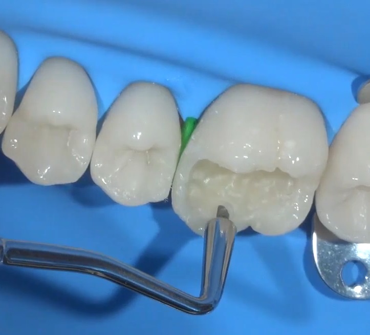 Instrument modelat compozit posterior S60(12) S300(19) Instrument modelat compozit posterior S60(12) S300(19) - imagine 7